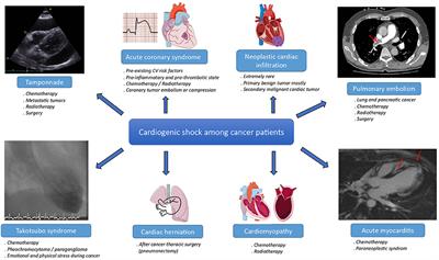 Cardiogenic shock among cancer patients